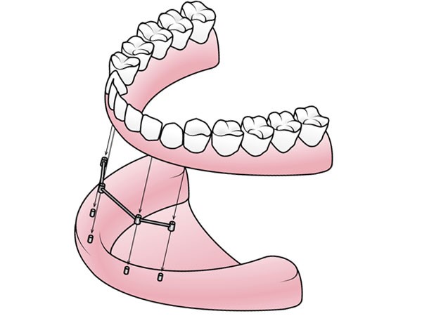 Young With Dentures Sterling Heights MI 48314